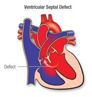 ventricular septal defect