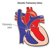 stenotic pulmonary valve