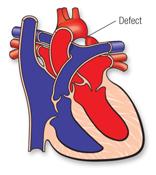stenotic aortic valve