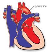 suture line