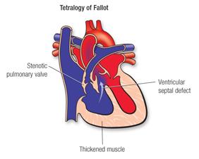 tetralogy fallot