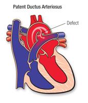 Parent ductus arteriosus