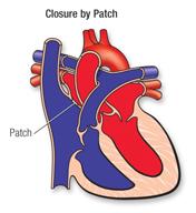 closure by patch
